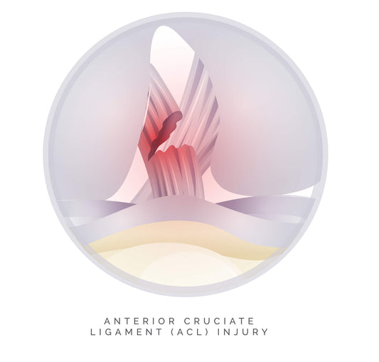 ACL: Las Tres Letras Que Ningún Deportista Quiere Escuchar